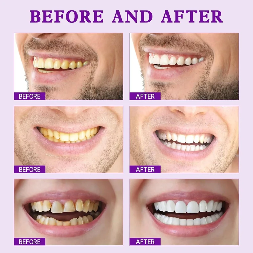 Purple Teeth Whitening Strips - 7/21 Whitening Sessions - Non Sensitive Teeth Whitening - Peroxide-Free