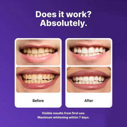 Purple Teeth Whitening Strips - 7/21 Whitening Sessions - Non Sensitive Teeth Whitening - Peroxide-Free