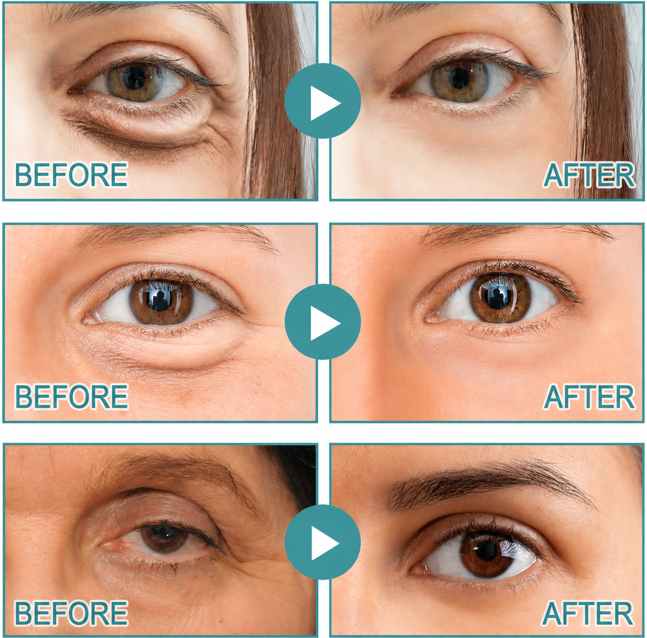 Dissolving Microneedle Eye Patches