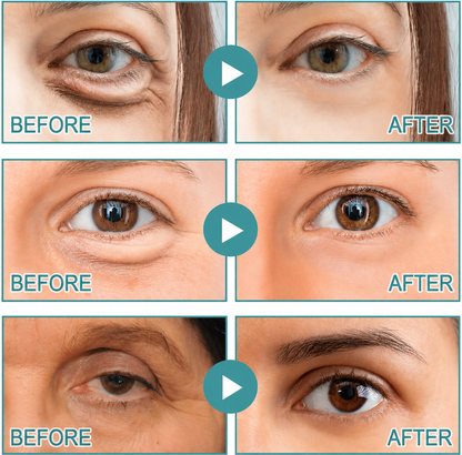 Dissolving Microneedle Eye Patches